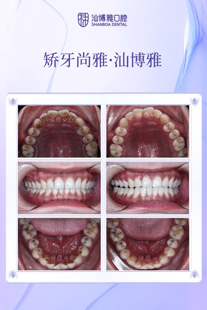 洗牙洁治案例 汕博雅口腔