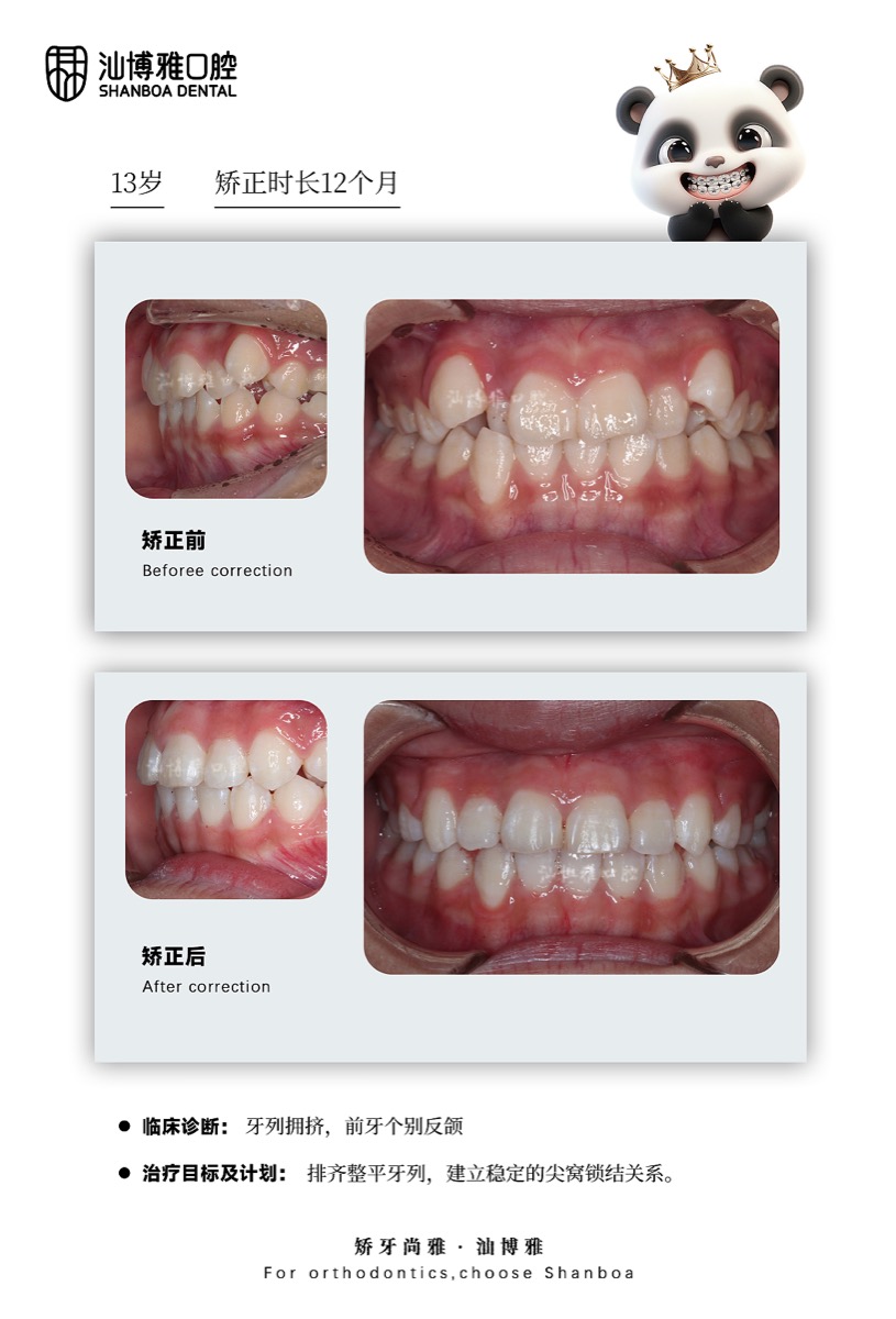 牙列拥挤矫正案例 汕博雅口腔