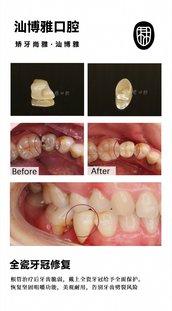 牙冠修复案例 汕博雅口腔