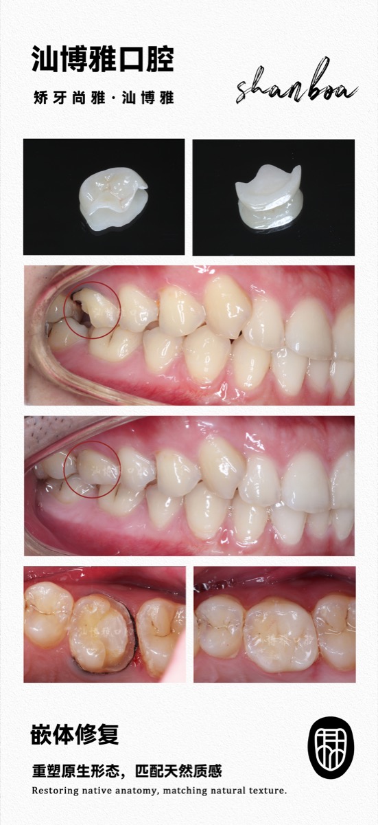 嵌体修复案例 汕博雅口腔