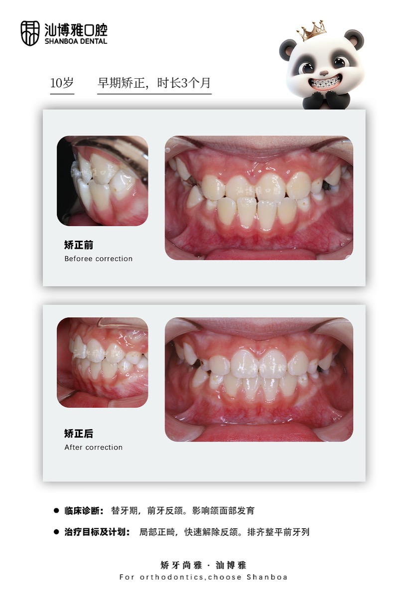 地包天矫正案例 汕博雅口腔