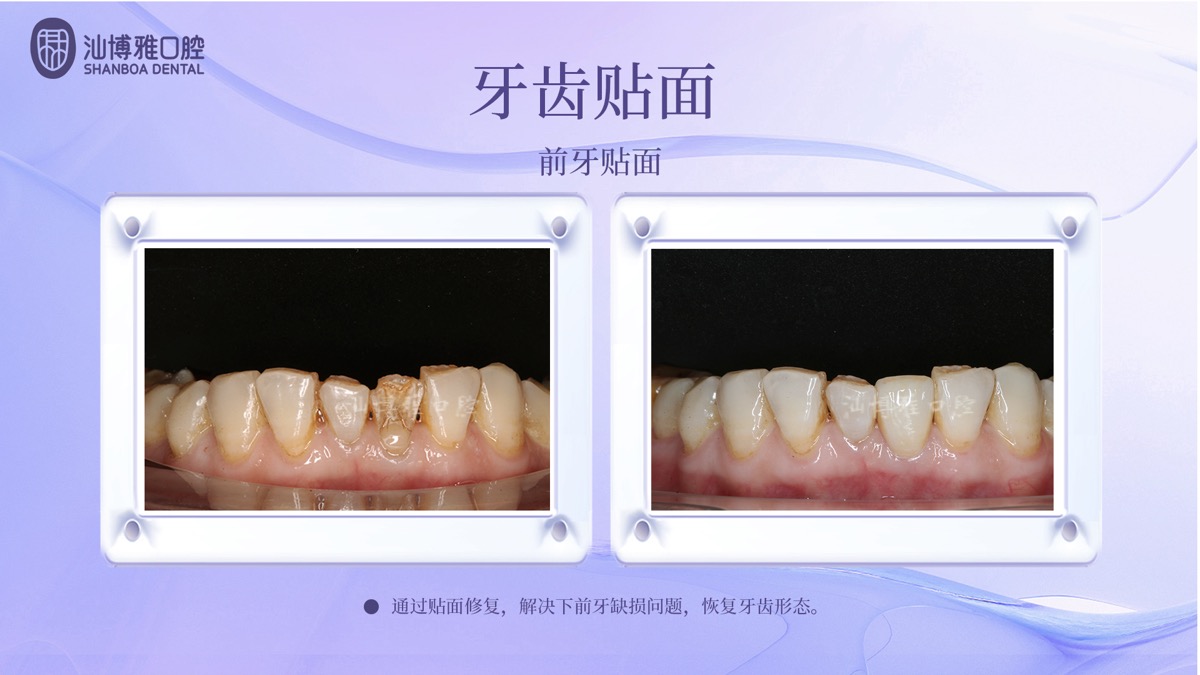 前牙贴面修复案例 汕博雅口腔